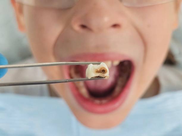 Best Emergency Dental Care for Broken or Chipped Teeth in Bottineau, ND